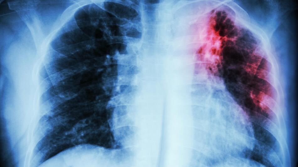 Tuberkulose auf Röntgenbild