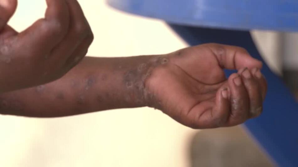 WHO ruft wegen Mpox weltweite Notlage aus