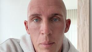 Rätselhafter Haarverlust bei Tobias Wolf belastet ihn psychisch stark