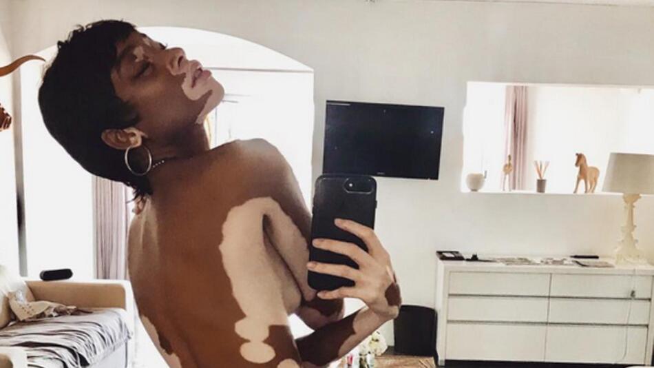 Winnie Harlow – Dieses Nackt-Selfie macht Mut
