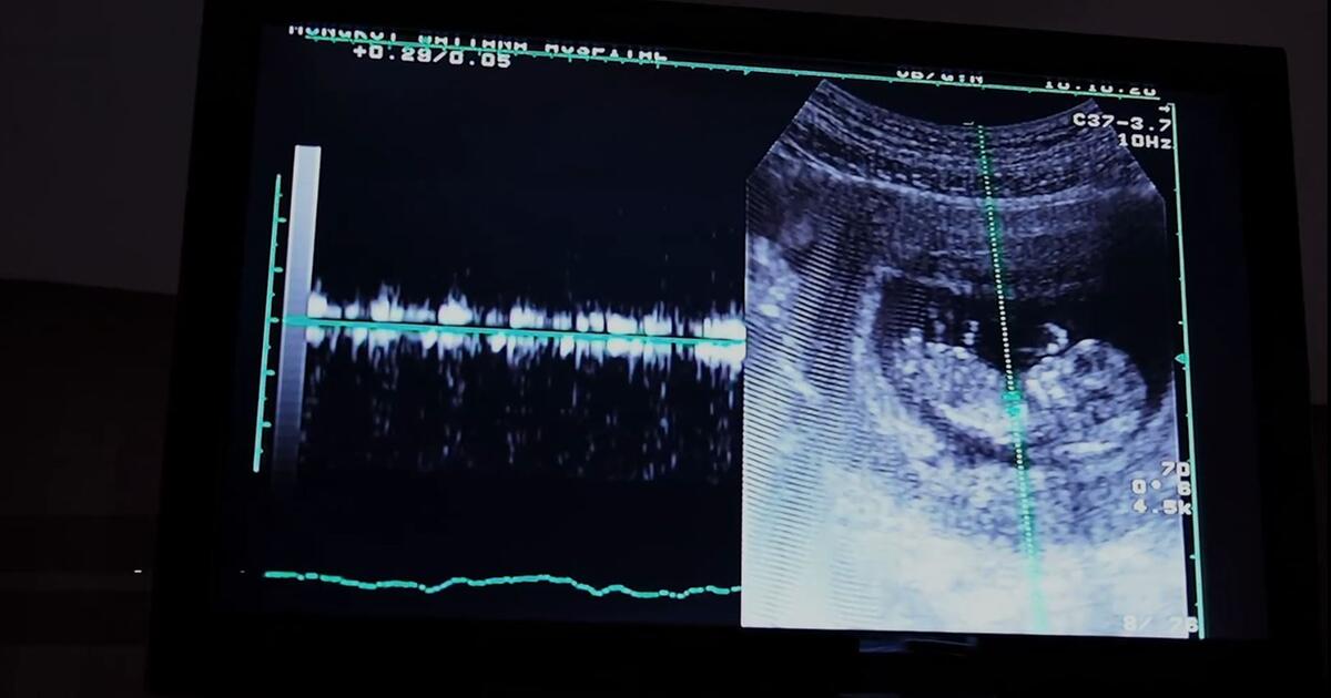 Studie Fünf Jahre nach Abtreibung überwiegt
