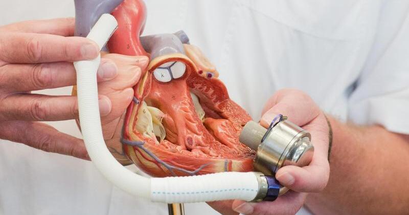 Drei Mal mehr künstliche Herzpumpen als vor zehn Jahren WEB.DE