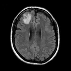 MRT-Aufnahme von Wurm im Gehirn