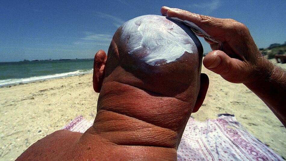 Gefahr durch UV-Strahlen: Das hilft gegen Sonnenbrand auf der Kopfhaut