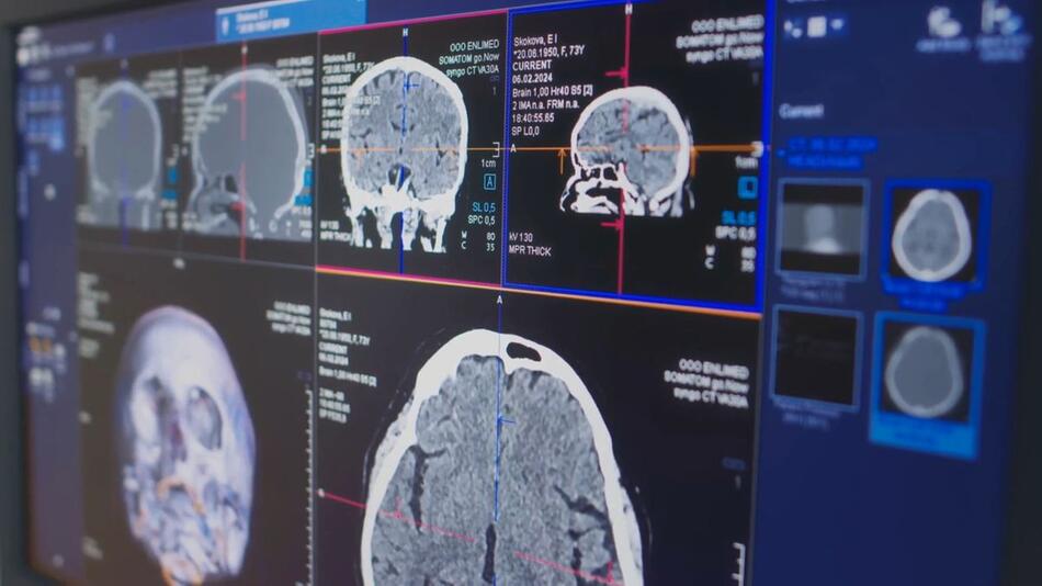 Erste Alzheimer-Therapie in EU zur Zulassung empfohlen