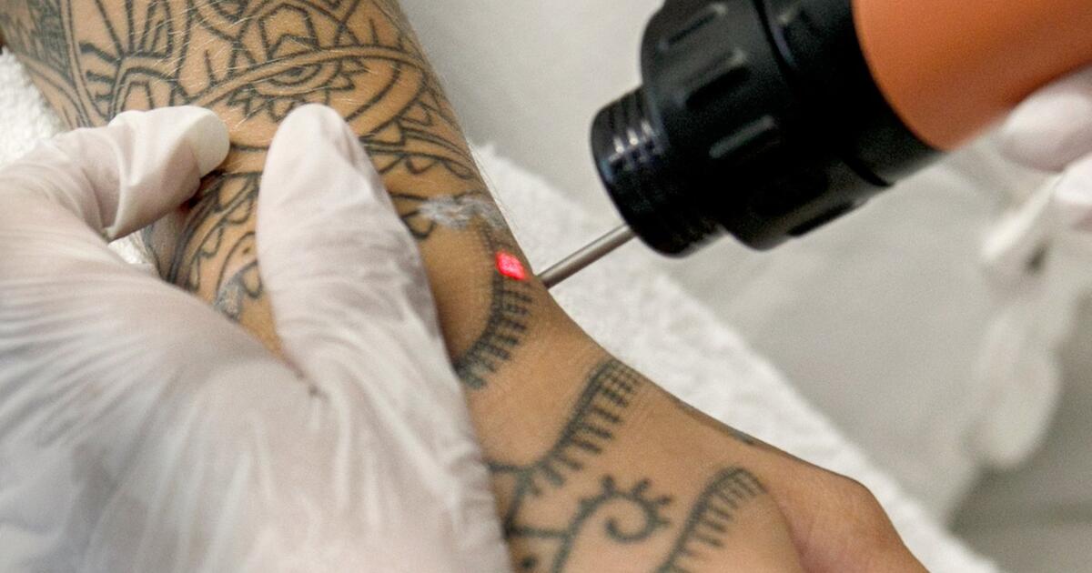 TattooEntfernung bald ein echter Luxus? WEB.DE