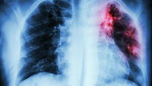 Röntgenbild eines Brustkorbes mit farblich hervorgehobenem Bereich